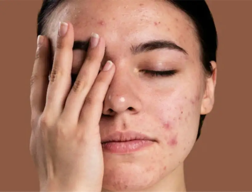  Natural -Remedies-dark-spots-